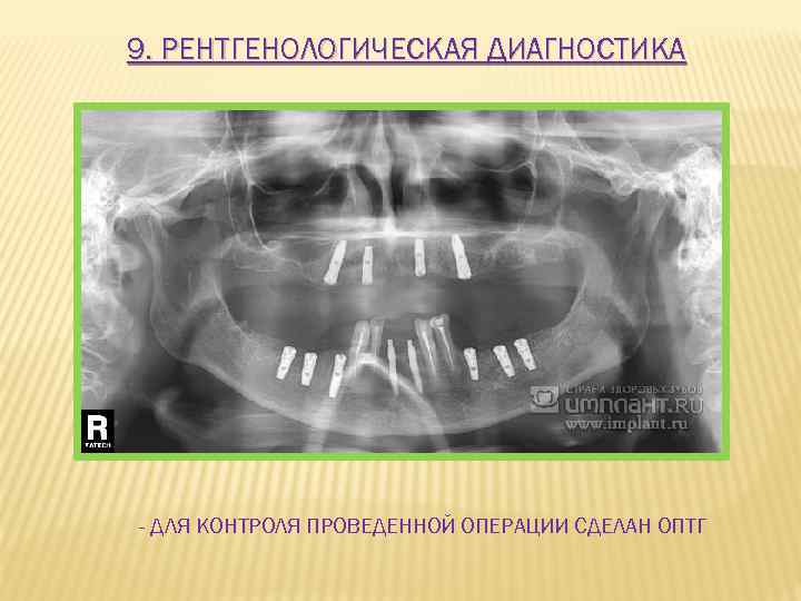 9. РЕНТГЕНОЛОГИЧЕСКАЯ ДИАГНОСТИКА - ДЛЯ КОНТРОЛЯ ПРОВЕДЕННОЙ ОПЕРАЦИИ СДЕЛАН ОПТГ 