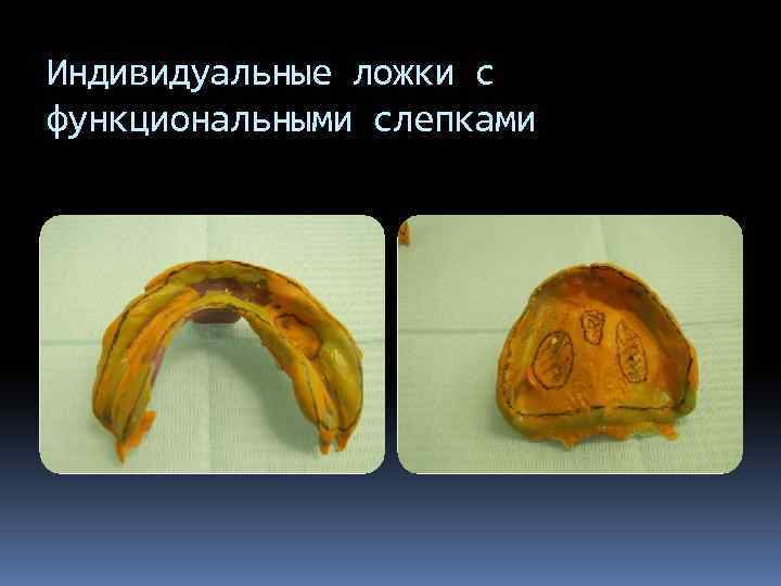 Индивидуальные ложки с функциональными слепками 