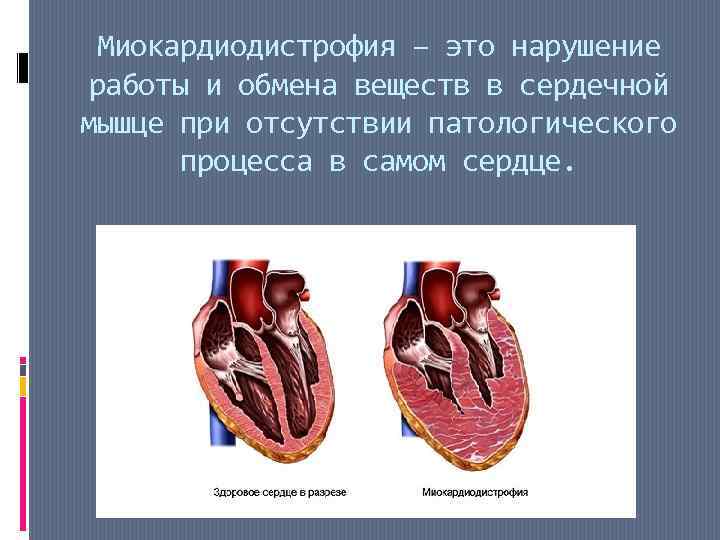 Миокардиодистрофия – это нарушение работы и обмена веществ в сердечной мышце при отсутствии патологического