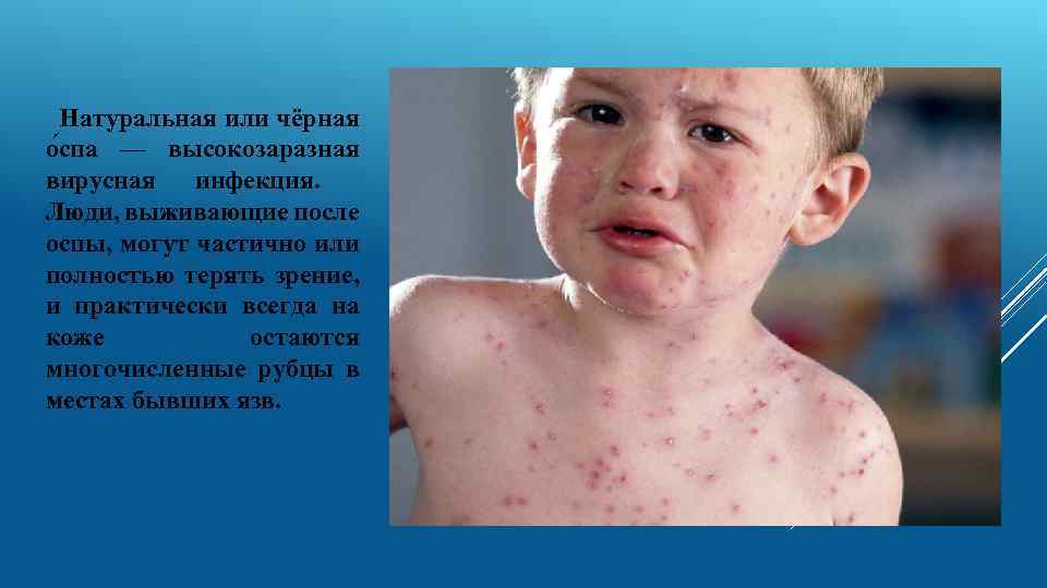 Натуральная или чёрная о спа — высокозаразная вирусная инфекция. Люди, выживающие после оспы, могут