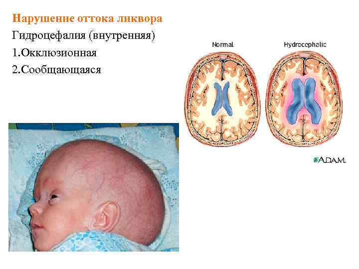 Виды гидроцефалии