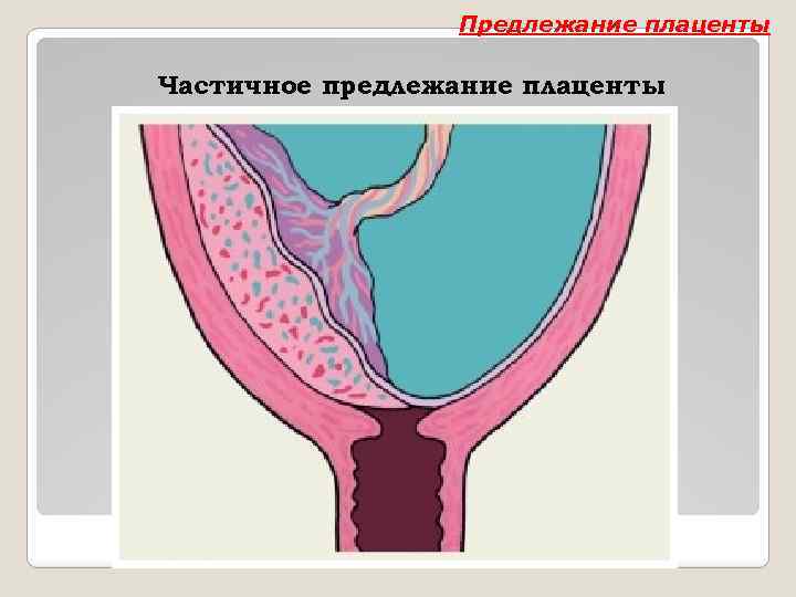 Полное предлежание при беременности. Предлежание плаценты. Частичнте предлежан е плацента. Частичное предлежание плаценты. Неполное предлежание плаценты.