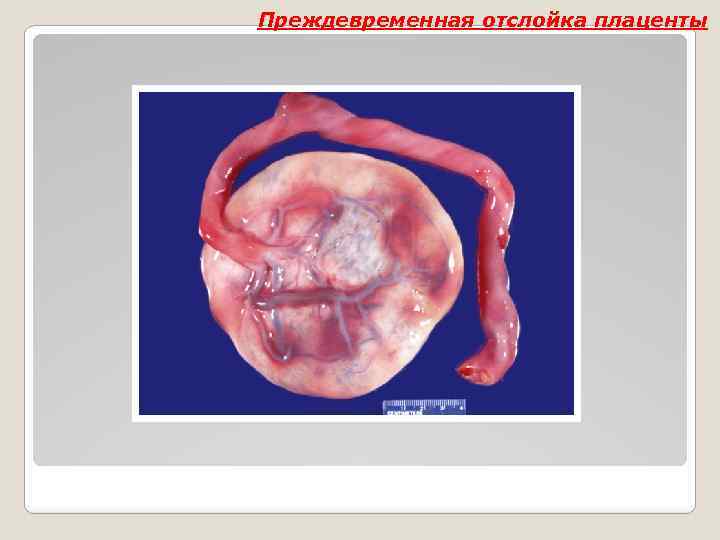 Преждевременная отслойка плаценты 