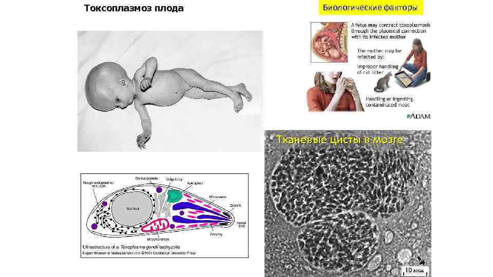 Токсоплазмоз плода Биологические факторы Тканевые цисты в мозге 