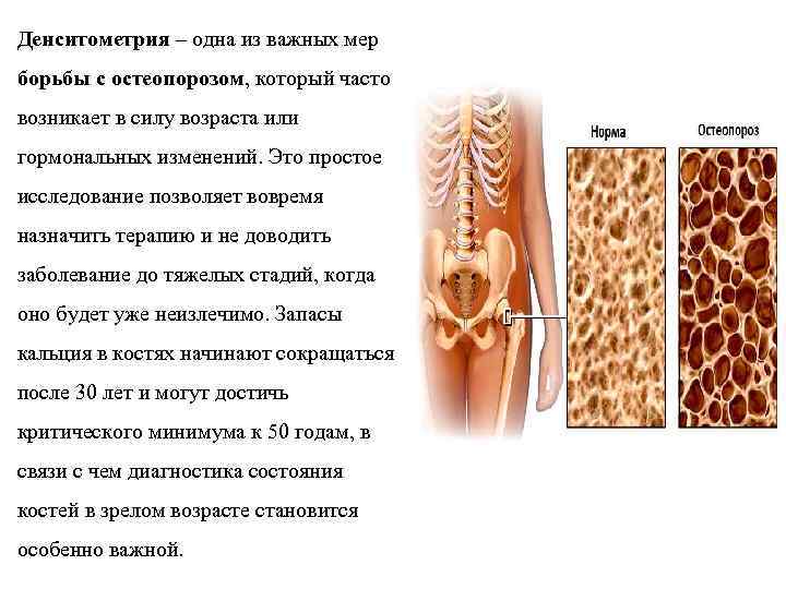 Денситометрия – одна из важных мер борьбы с остеопорозом, который часто возникает в силу