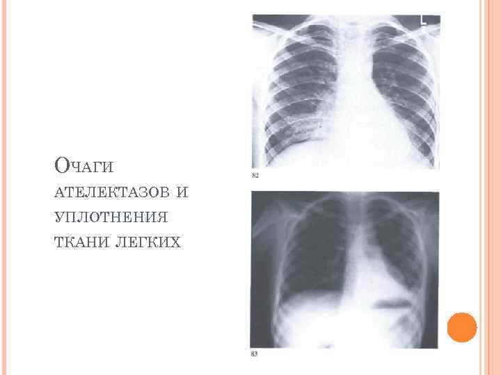 ОЧАГИ АТЕЛЕКТАЗОВ И УПЛОТНЕНИЯ ТКАНИ ЛЕГКИХ 