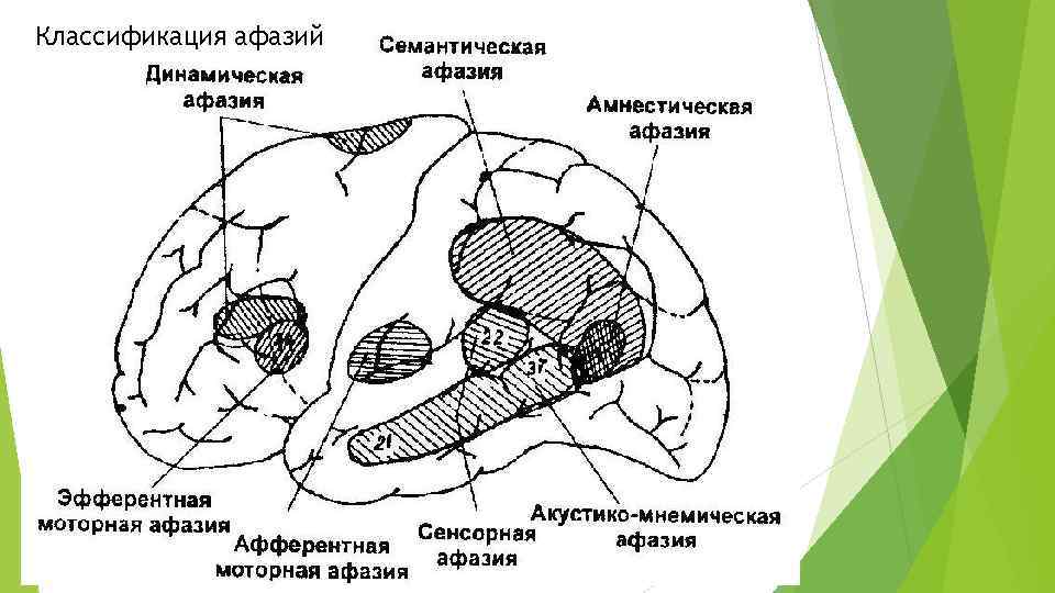 Классификация афазий 