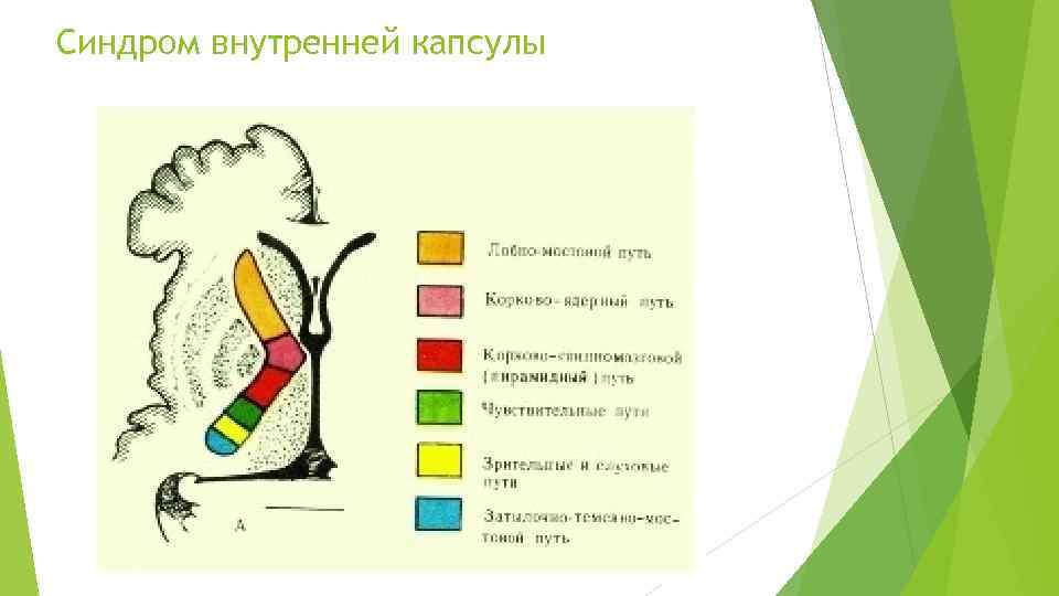 Синдром внутренней капсулы 