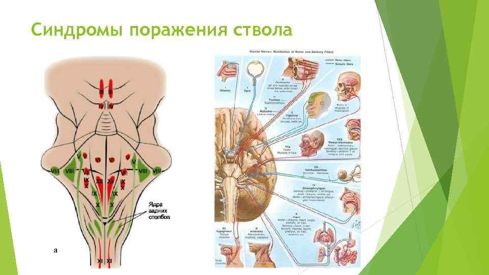 Синдромы поражения ствола 