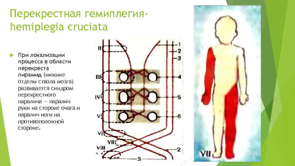 Перекрестная гемиплегияhemiplegia cruciata При локализации процесса в области перекреста пирамид (нижние отделы ствола мозга)