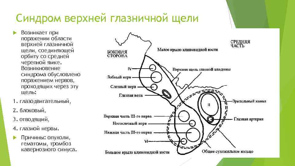 Синдром верхней глазничной щели Возникает при поражении области верхней глазничной щели, соединяющей орбиту со