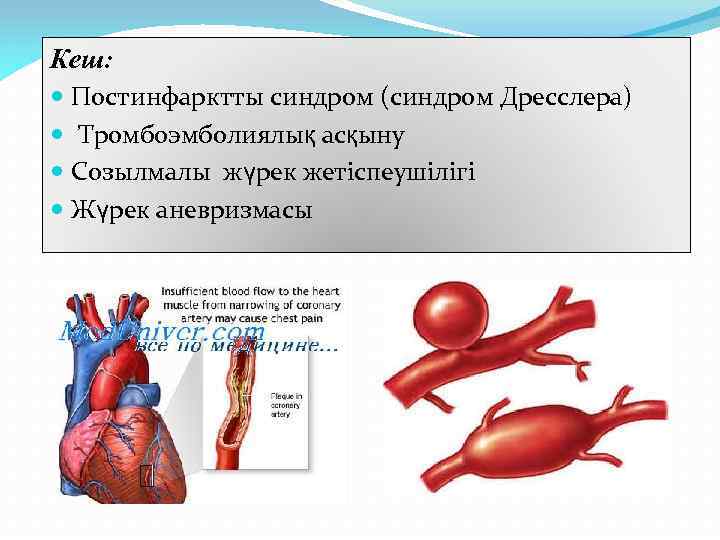 Синдром дресслера презентация