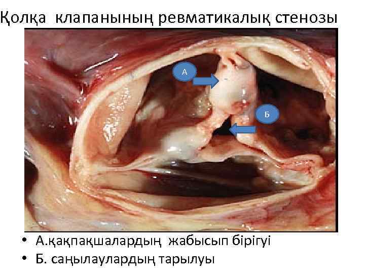 Қолқа клапанының ревматикалық стенозы А Б • А. қақпақшалардың жабысып бірігуі • Б. саңылаулардың