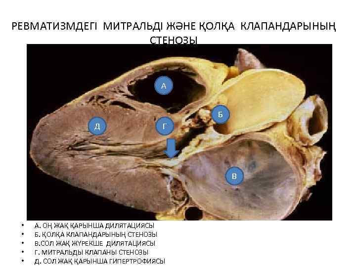 РЕВМАТИЗМДЕГІ МИТРАЛЬДІ ЖӘНЕ ҚОЛҚА КЛАПАНДАРЫНЫҢ СТЕНОЗЫ А Б Д Г В • • •