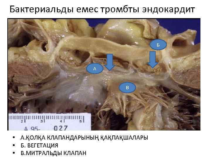  Бактериальды емес тромбты эндокардит Б А В • А. ҚОЛҚА КЛАПАНДАРЫНЫҢ ҚАҚПАҚШАЛАРЫ •