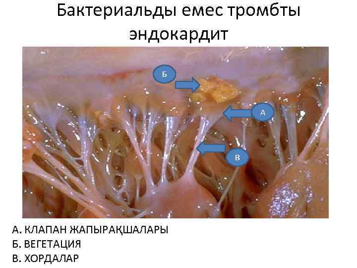 Бактериальды емес тромбты эндокардит Б А В А. КЛАПАН ЖАПЫРАҚШАЛАРЫ Б. ВЕГЕТАЦИЯ В. ХОРДАЛАР