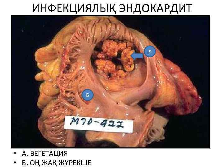 ИНФЕКЦИЯЛЫҚ ЭНДОКАРДИТ А Б • А. ВЕГЕТАЦИЯ • Б. ОҢ ЖАҚ ЖҮРЕКШЕ 