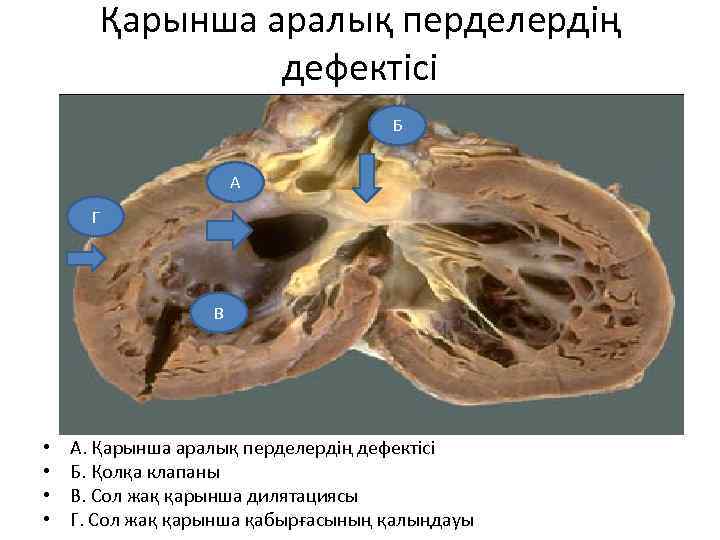 Қарынша аралық перделердің дефектісі Б А Г В • • А. Қарынша аралық перделердің