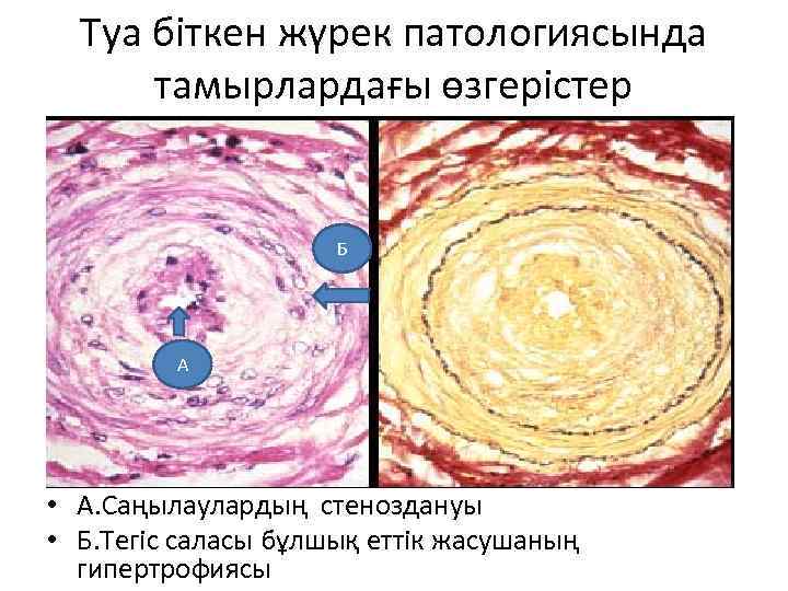 Туа біткен жүрек патологиясында тамырлардағы өзгерістер Б А • А. Саңылаулардың стеноздануы • Б.