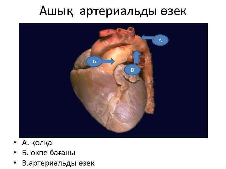 Ашық артериальды өзек А Б В • А. қолқа • Б. өкпе бағаны •