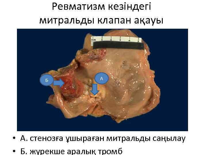 Ревматизм кезіндегі митральды клапан ақауы Б А • А. стенозға ұшыраған митральды саңылау •