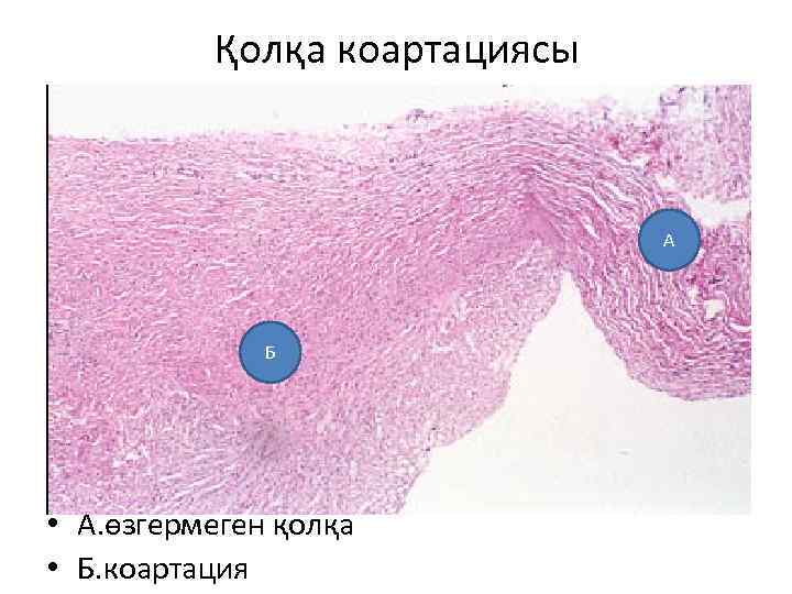 Қолқа коартациясы А Б • А. өзгермеген қолқа • Б. коартация 