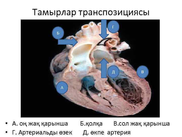 Тамырлар транспозициясы Г Б Д В А • А. оң жақ қарынша Б. қолқа