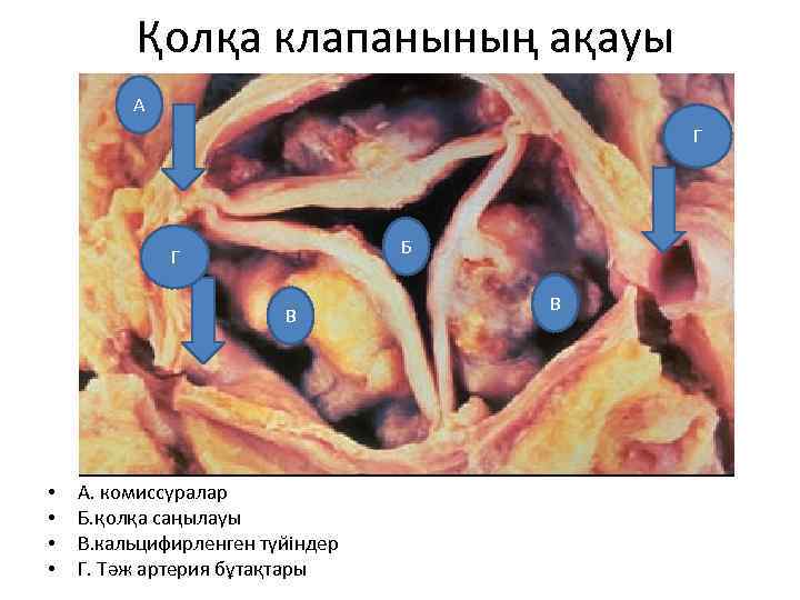  Қолқа клапанының ақауы А Г Б Г В • • А. комиссуралар Б.