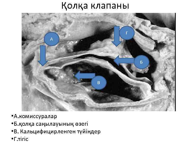 Қолқа клапаны Г А Б В • А. комиссуралар • Б. қолқа саңылауының өзегі