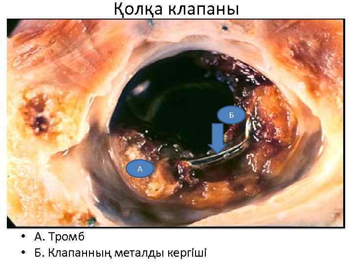 Қолқа клапаны Б А • А. Тромб • Б. Клапанның металды кергіші 