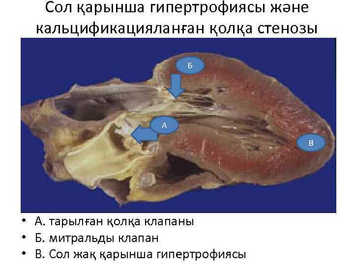 Сол қарынша гипертрофиясы және кальцификацияланған қолқа стенозы Б А В • А. тарылған қолқа