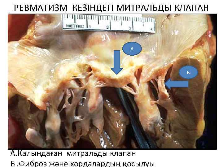 РЕВМАТИЗМ КЕЗІНДЕГІ МИТРАЛЬДЫ КЛАПАН А Б А. Қалындаған митральды клапан Б. Фиброз және хордалардың