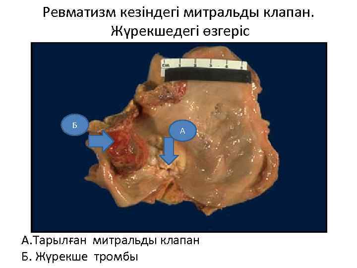 Ревматизм кезіндегі митральды клапан. Жүрекшедегі өзгеріс Б А А. Тарылған митральды клапан Б. Жүрекше