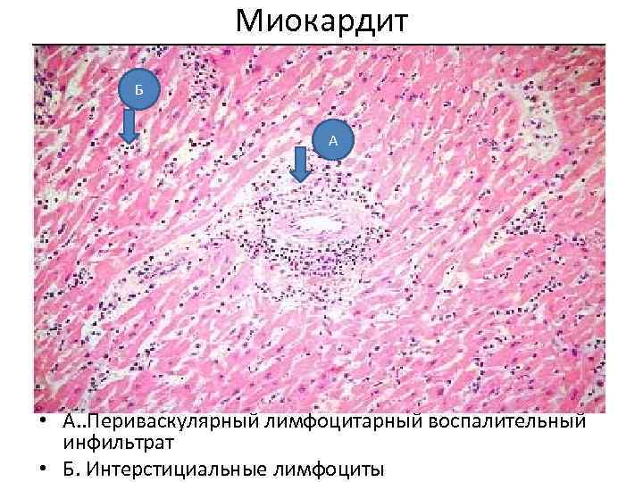 Миокардит Б А • А. . Периваскулярный лимфоцитарный воспалительный инфильтрат • Б. Интерстициальные лимфоциты