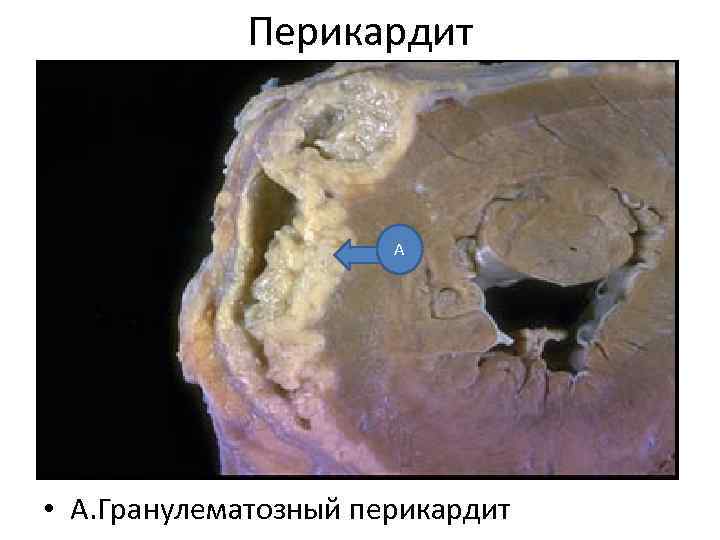 Перикардит А • А. Гранулематозный перикардит 