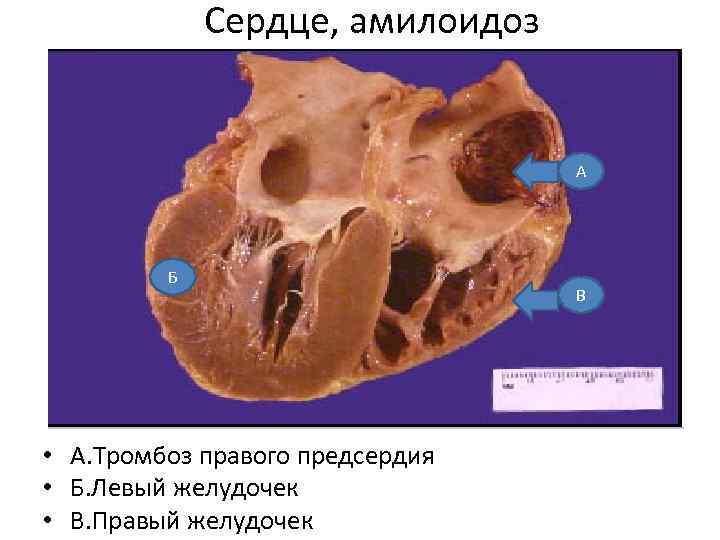 Сердце, амилоидоз А Б • А. Тромбоз правого предсердия • Б. Левый желудочек •