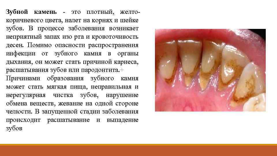 Зубной камень - это плотный, желтокоричневого цвета, налет на корнях и шейке зубов. В