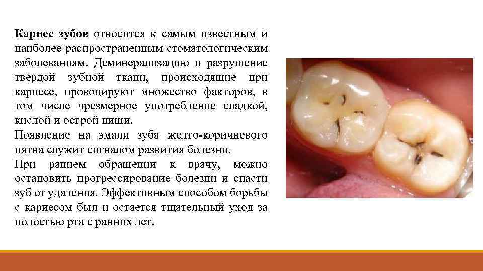 Кариес зубов относится к самым известным и наиболее распространенным стоматологическим заболеваниям. Деминерализацию и разрушение