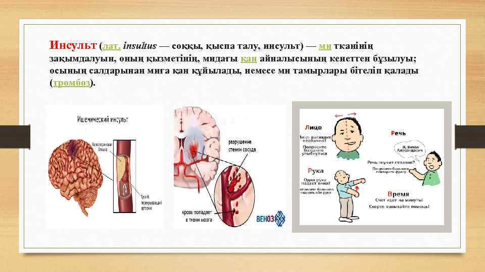 Инсульт (лат. insultus — соққы, қыспа талу, инсульт) — ми тканінің зақымдалуын, оның қызметінің,
