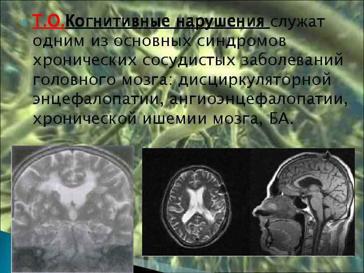  Т. О. Когнитивные нарушения служат одним из основных синдромов хронических сосудистых заболеваний головного