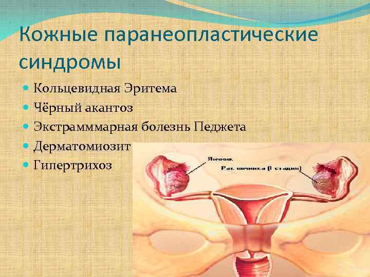 Кожные паранеопластические синдромы Кольцевидная Эритема Чёрный акантоз Экстрамммарная болезнь Педжета Дерматомиозит Гипертрихоз 