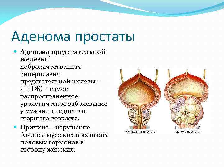 Аденома простаты Аденома предстательной железы ( доброкачественная гиперплазия предстательной железы – ДГПЖ) – самое