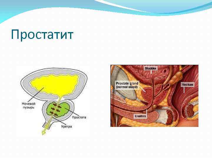 Простатит 