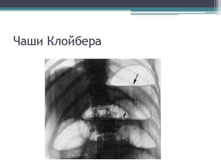 Чаши Клойбера 