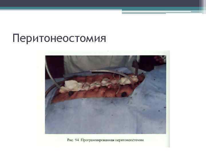 Перитонеостомия 