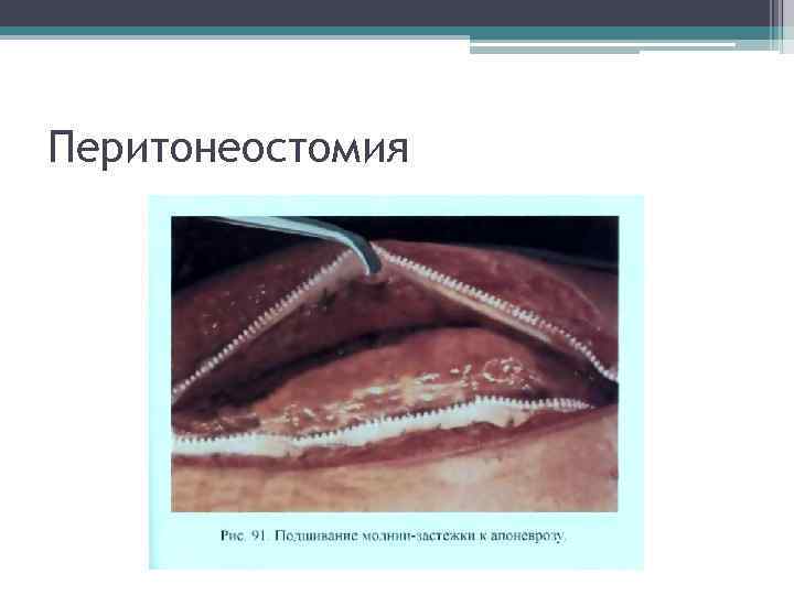 Перитонеостомия 