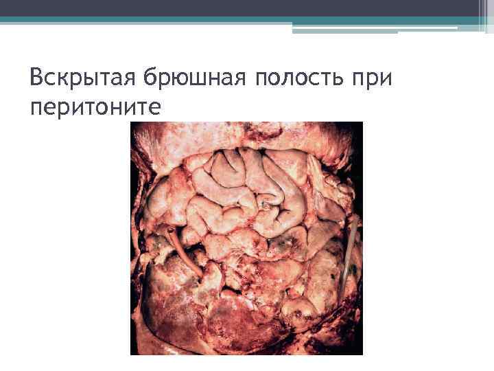Вскрытая брюшная полость при перитоните 