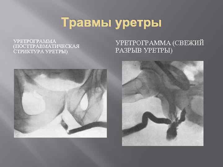 Травмы уретры УРЕТРОГРАММА (ПОСТТРАВМАТИЧЕСКАЯ СТРИКТУРА УРЕТРЫ) УРЕТРОГРАММА (СВЕЖИЙ РАЗРЫВ УРЕТРЫ) 