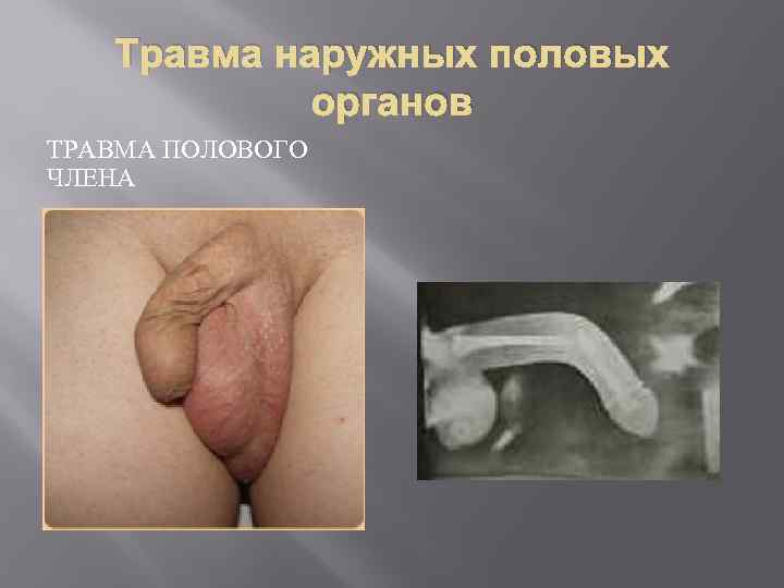 Травма наружных половых органов ТРАВМА ПОЛОВОГО ЧЛЕНА 