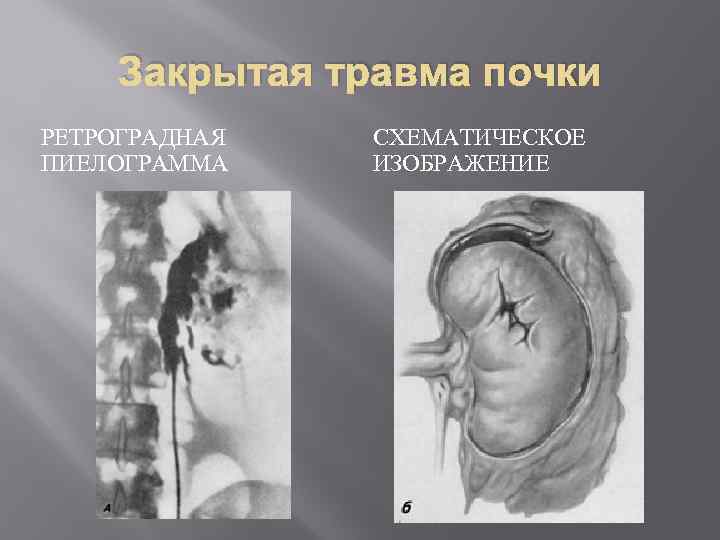 Закрытая травма почки РЕТРОГРАДНАЯ ПИЕЛОГРАММА СХЕМАТИЧЕСКОЕ ИЗОБРАЖЕНИЕ 